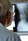 Shrinking Tumors With Hormone Therapy: Are Bones Safe?